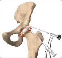 Hip Arthroscopy