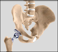 Revision Hip Replacement