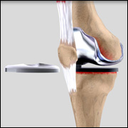 Revision knee Replacement